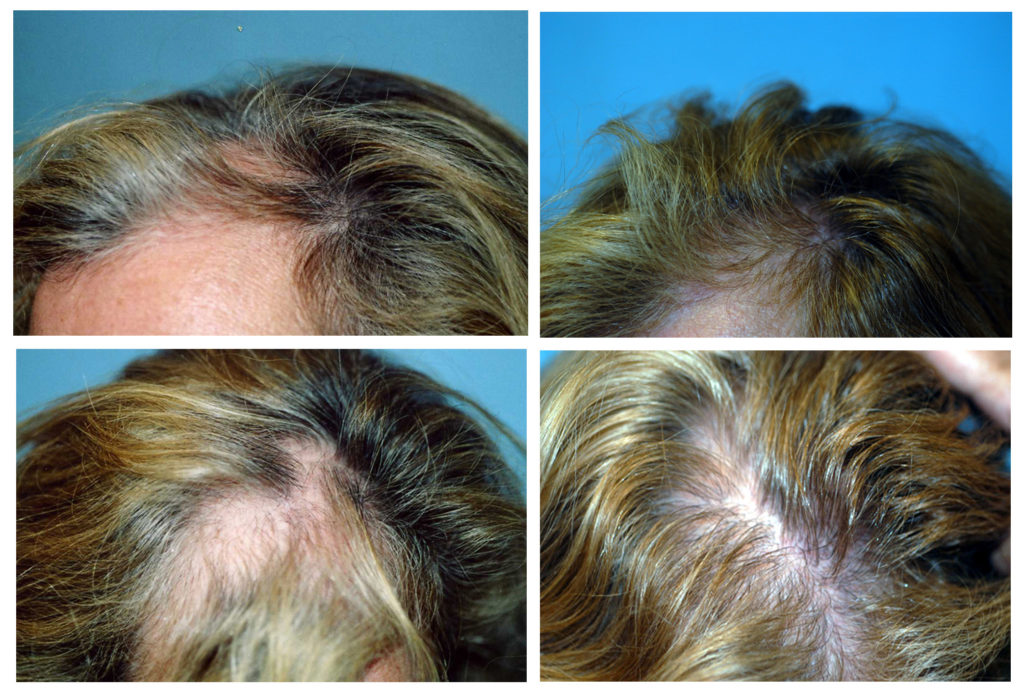 Hair Loss for Women | Dr. Paul J. McAndrews, MD | Hair Growth Doctor