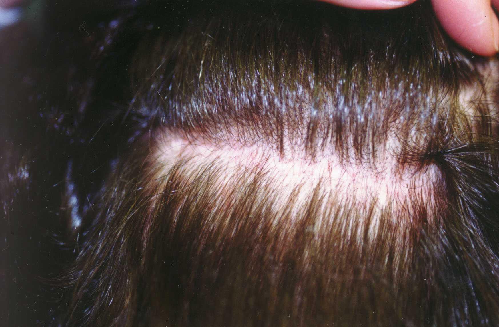 Linear scar following FUT