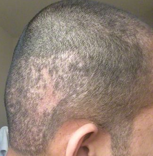 Scar tissue in donor region following thousands of punch FUE hair transplant