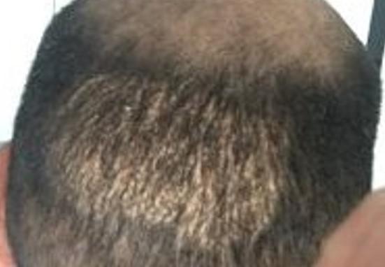 Punch scars following an FUE hair transplant