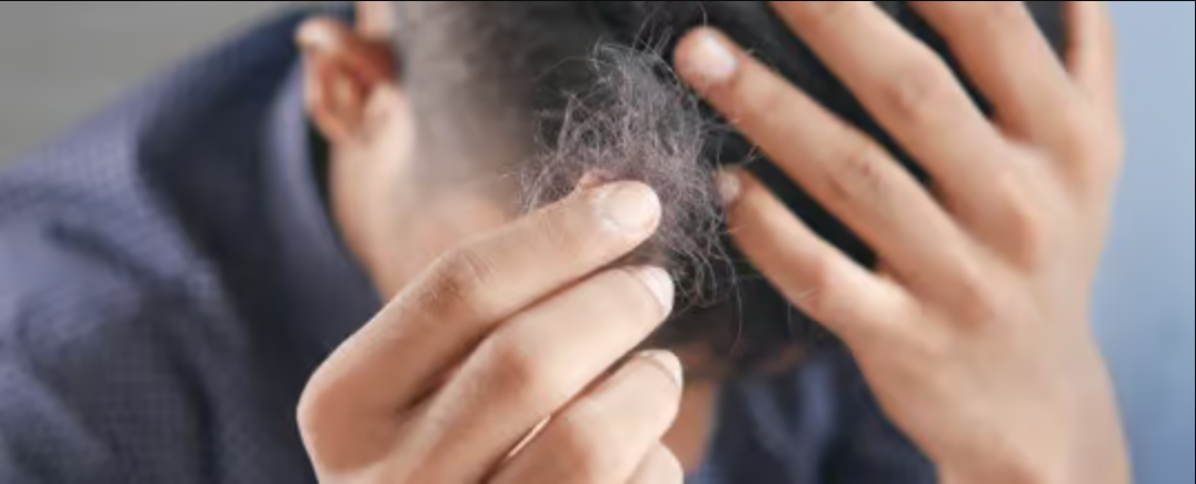 Diagnosing Reasons for Hair Loss