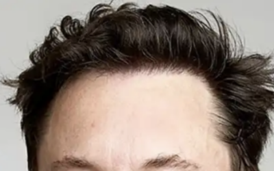 What Does a Natural Hair Transplant Look Like?