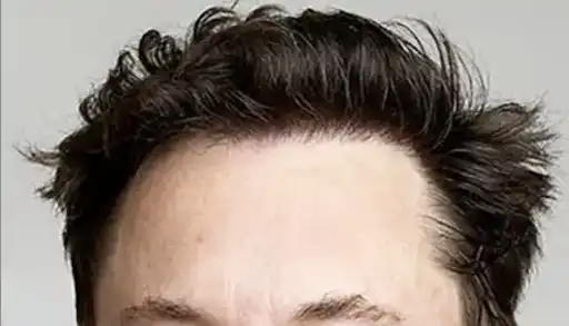 What Does a Natural Hair Transplant Look Like?