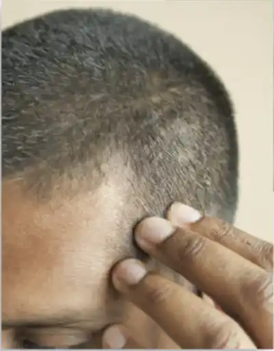 Is Exercise Bad After a Hair Transplant?
