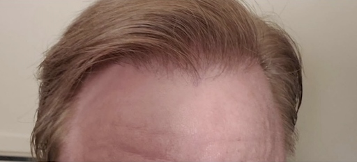 Correction hair transplant result