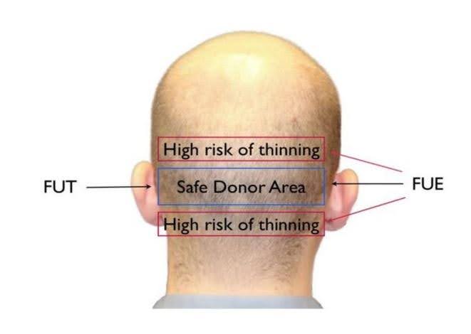 Donor areas for FUE and FUT hair transplants.