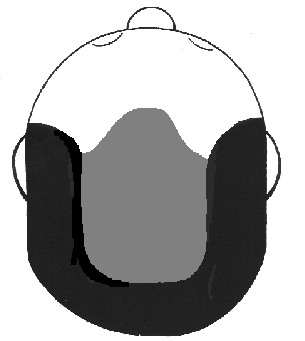 density before a hair transplant