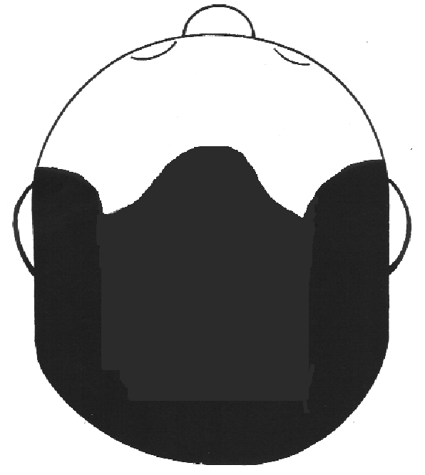 post hair transplant density.