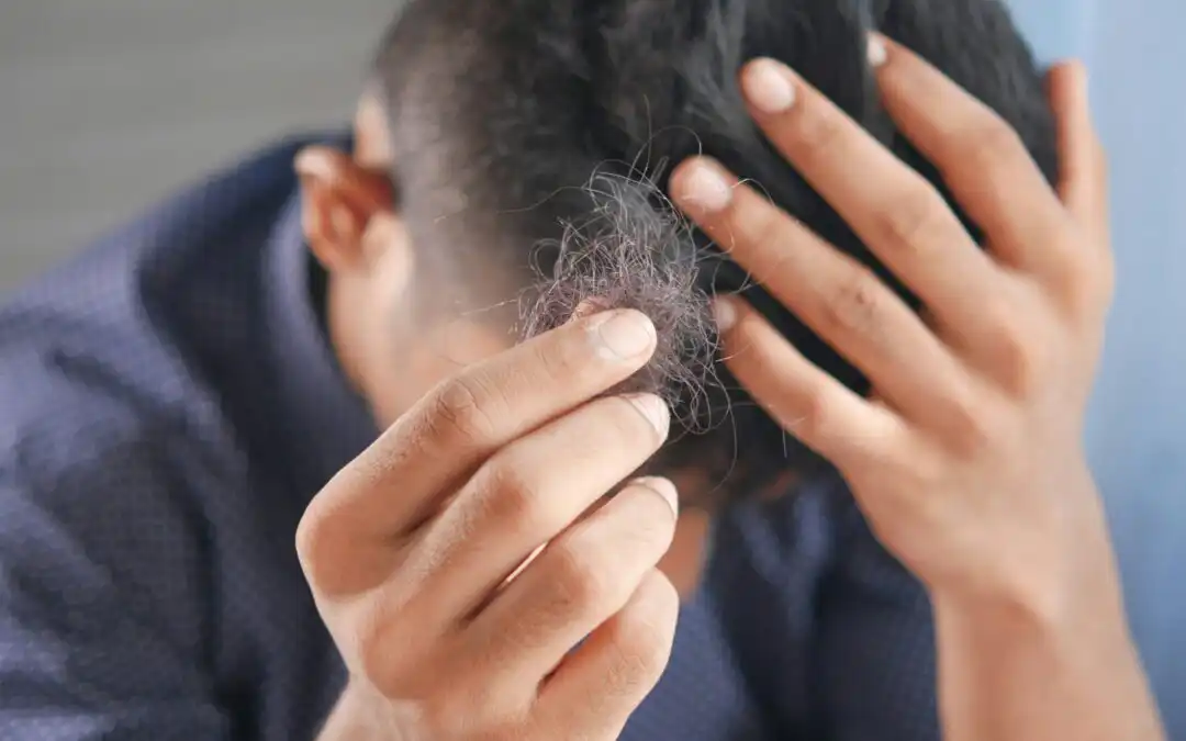 Shock Hair Loss After a Hair Transplant