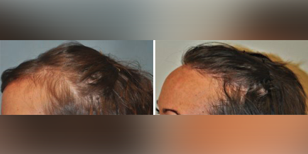 Before and after photos of a female patient after a hair transplant done by Dr. McAndrews.