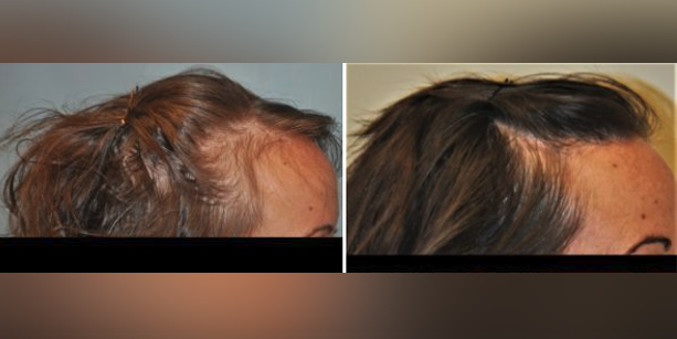Before and after photos of a female patient after a hair transplant done by Dr. McAndrews.