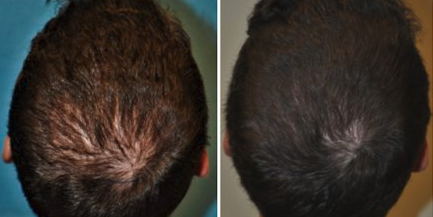 Before and after photos of a male patient after a hair transplant done by Dr. McAndrews.