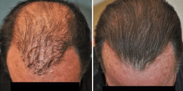 Before and after photos of a male patient after a corrective hair transplant done by Dr. McAndrews.