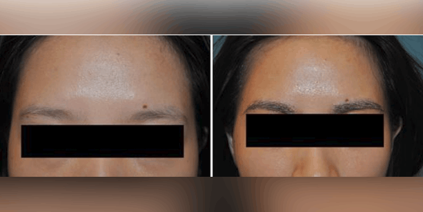 Before and after photos of a female patient after an eyebrow transplant done by Dr. McAndrews.