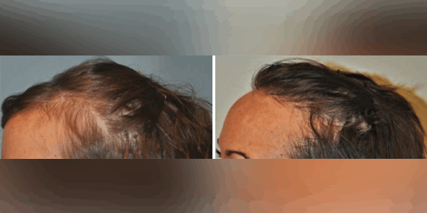 Before and after photos of a female patient after a hair transplant done by Dr. McAndrews.