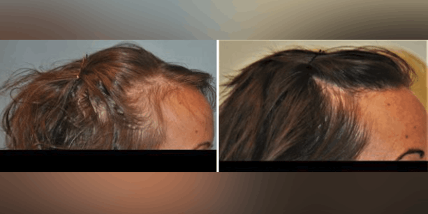 Before and after photos of a female patient after a hair transplant done by Dr. McAndrews.
