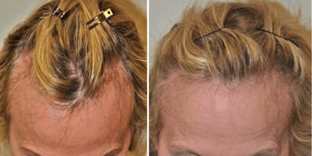 Before and after photos of a female patient after a hair transplant done by Dr. McAndrews.