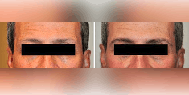Before and after photos of a male patient after an eyebrow transplant done by Dr. McAndrews.