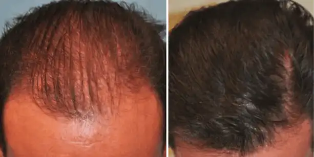 Before and after photos of a male patient after a hair transplant done by Dr. McAndrews.