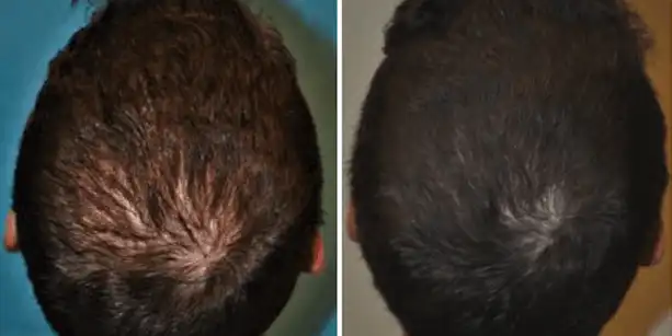 Before and after photos of a 31 year old male patient after a hair transplant performed by Dr. Paul J. McAndrews.