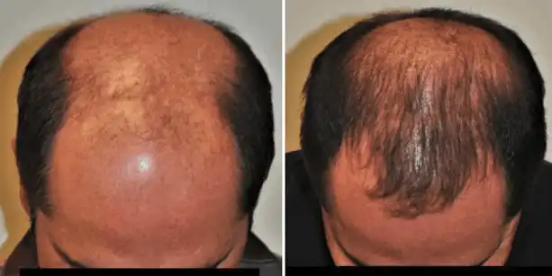 Before and after photos of a male patient after a hair transplant done by Dr. McAndrews.