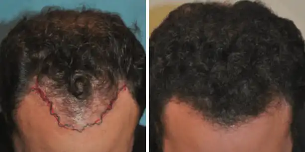 Before and after photos of a male patient after a hair transplant done by Dr. McAndrews.
