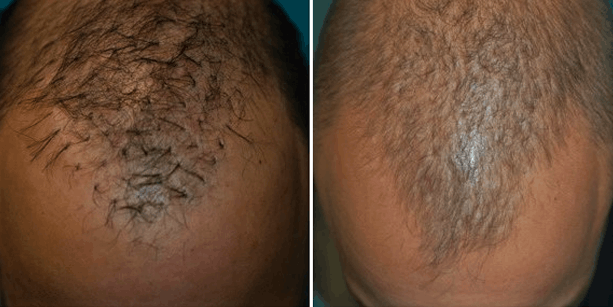 Before and after photos of a male patient after a punch removal corrective hair transplant done by Dr. McAndrews.