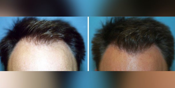 Dr-McAndrews-CA-MALE-HAIR-TRANSPLANT4
