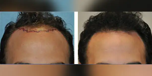 Dr-McAndrews-CA-MALE-HAIR-TRANSPLANT3