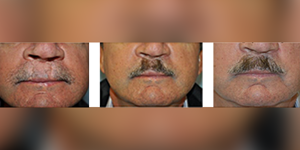 Dr-McAndrews-CA-FEMALE-HAIR-TRANSPLANT3