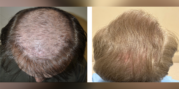 Dr-McAndrews-CA-MALE-HAIR-TRANSPLANT4