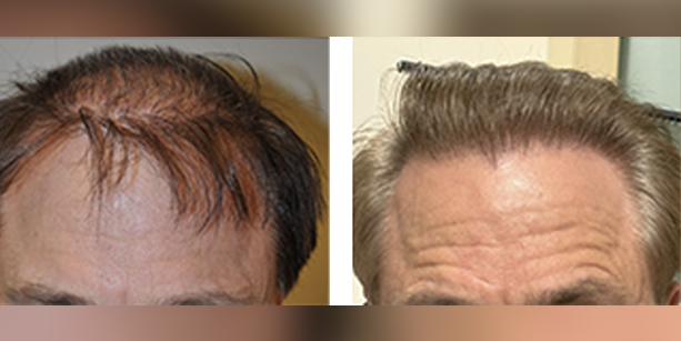 Dr-McAndrews-CA-MALE-HAIR-TRANSPLANT3