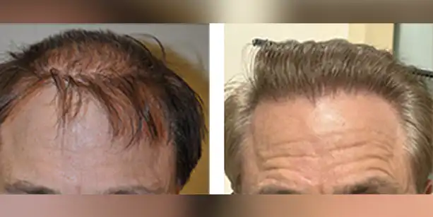 Dr-McAndrews-CA-MALE-HAIR-TRANSPLANT3