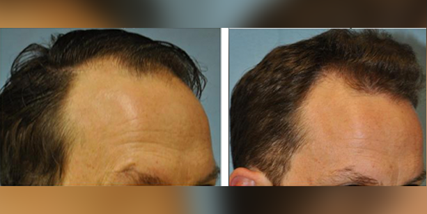 Dr-McAndrews-CA-MALE-HAIR-TRANSPLANT3