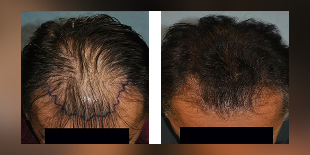 Dr-McAndrews-CA-MALE-HAIR-TRANSPLANT4