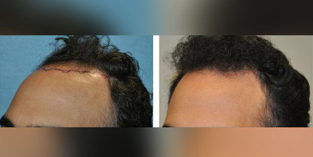 Dr-McAndrews-CA-MALE-HAIR-TRANSPLANT3