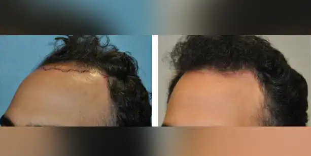 Dr-McAndrews-CA-MALE-HAIR-TRANSPLANT3