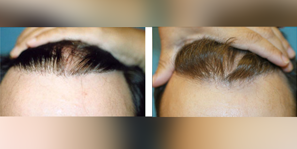 Dr-McAndrews-CA-MALE-HAIR-TRANSPLANT4