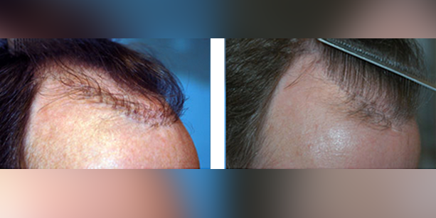Dr-McAndrews-CA-MALE-HAIR-TRANSPLANT4