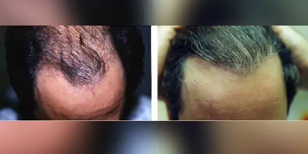 Dr-McAndrews-CA-MALE-HAIR-TRANSPLANT3