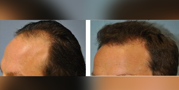 Dr-McAndrews-CA-MALE-HAIR-TRANSPLANT3