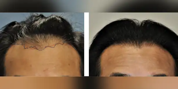 Dr-McAndrews-CA-MALE-HAIR-TRANSPLANT4