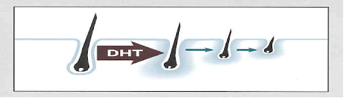 DHT causing miniaturization of the hair follicle.