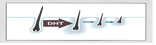 DHT causing miniaturization of the hair follicle.