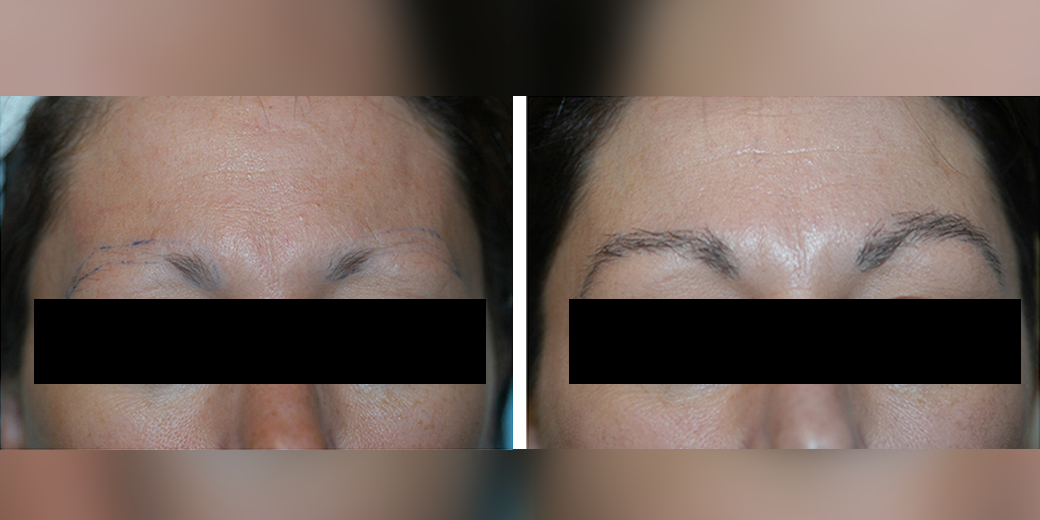 Before and after photos of a female patient after a successful eyebrow transplant performed by Dr. Paul J. McAndrews.