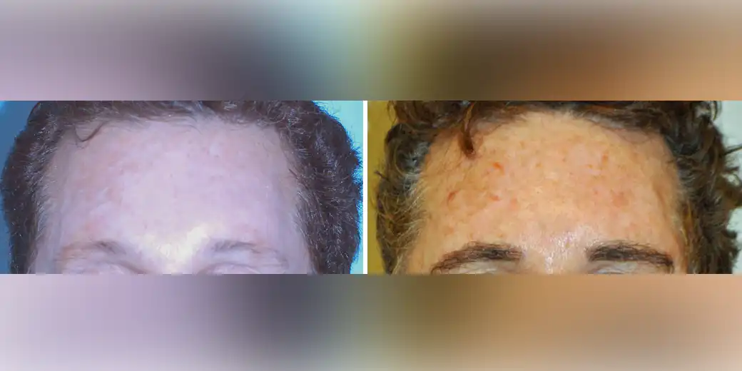 Before and after photos of a male patient after a successful eyebrow transplant performed by Dr. Paul J. McAndrews.