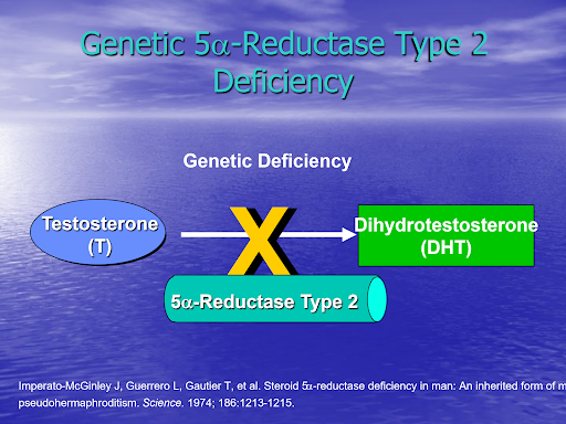 No conversion of testosterone into dihydrotestosterone because of absence of 5 Alpha reductase type 2.