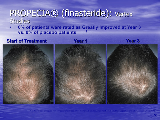 Before and after photos of a man's vertex using finasteride.