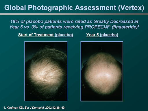Before and after photo of a placebo in Propecia study,