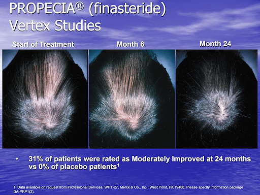 Before and after photos of a man's vertex using finasteride.